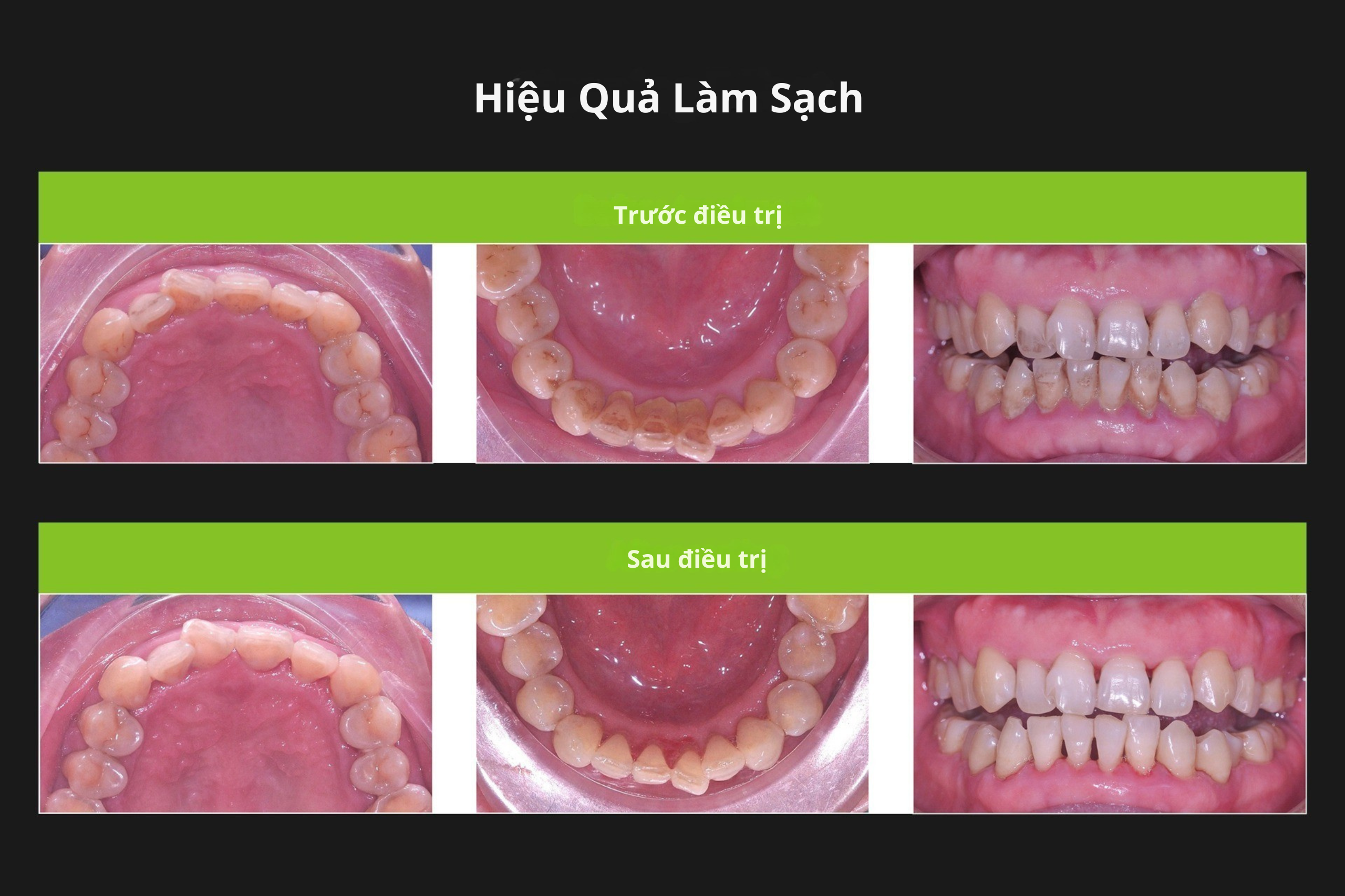 Máy Lấy Cao Răng Thông Minh VRN-Q5